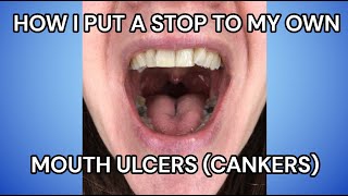 Best Mouth Ulcer  Canker Home Remedy Treatment IBD Sufferers [upl. by Gladwin]