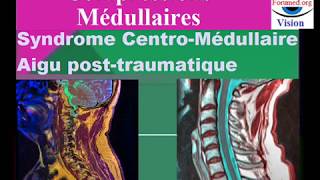 Compression Médullaire Syndrome centromédullaire posttraumatique [upl. by Ellicott692]