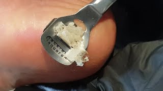 Pedicure  Pedicure At Home DIY Hard Dead Skin Removal [upl. by Noelyn]