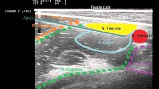 Bloqueo del Nervio Femoral Ecoguiadowmv [upl. by Magnien]