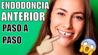 ENDODONCIA EN EL DIENTE DELANTERO ME ROMPÍ UN DIENTE COMO ES UNA ENDODONCIA COMO MTAR EL NERVIO [upl. by Ettenahs]