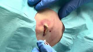 Cyst Incision amp Drainage [upl. by Eimile]