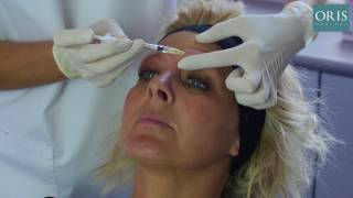 Botox Treatment for The Glabella Complex [upl. by Reece562]