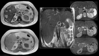 34 MR Imaging of Hepatic Adenomas Subtypes and Their Management  Part 1 By Dr Alice Fung [upl. by Laddie693]