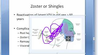 Microbiology 457 b Zoster Shingles VZV Varicella Zoster Virus ophthalmicus ramsay hunt acyclovir [upl. by Pickering]