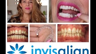 Départ pour un nouveau sourire avec INVISALIGN découvrez lévolution future de mes dents [upl. by Bocaj]