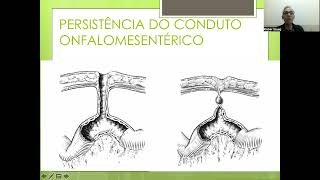 AULA DE DIVERTÍCULO DE MECKEL OU PERSISTÊNCIA DO CONDUTO ONFALOMESENTÉRICO [upl. by Moir755]