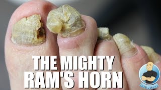 OVERGROWN RAMS HORN TOENAIL REMOVAL [upl. by Budworth]