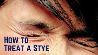 how to treat a stye in your eye [upl. by Corbie]