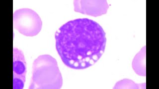 Vacuolated and basophilic blasts of Burkitt Lymphoma [upl. by Kasevich]