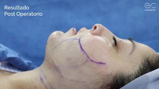 LIPOESCULTURA FACIALMENTON  Evoclinc Dr Jose Luis Salas [upl. by Eyahs]