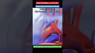 Atrial Fibrillation and Brain stroke l Blood clot shorts [upl. by Marja]