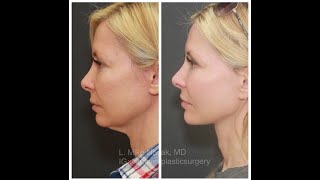 The Truth about Face and Neck Lift Incisions [upl. by Rotberg531]