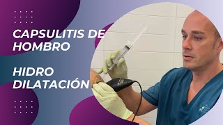 Capsulitis de Hombro Hidrodilatación [upl. by Annairb]