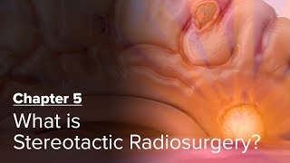 What is Stereotactic Radiosurgery Chapter 5 — Brain Metastases A Documentary [upl. by Woodberry466]