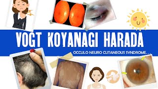 Vogt Koyanagi Harada syndrome  VKH  granulomatous uveitis  ophthalmology [upl. by Nairehs]