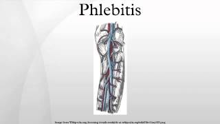 Phlebitis [upl. by Pyle]