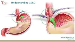 H pylori Infections Acid Reflux and Peptic Ulcers [upl. by Eerized]