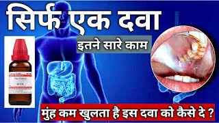 NUXVOMICA। submucous Fibrosis। मुंह के कम खुलने की रामबाण दवा। OSMF medicine। Homiopathy [upl. by Standford]