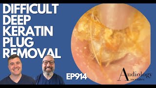 DIFFICULT DEEP KERATIN PLUG REMOVAL  EP914 [upl. by Gilbert806]