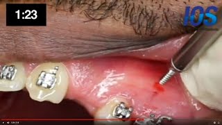 Placement of orthodontic mini implant Temporary Anchorage Device TADs Infinity IOS [upl. by Ennairam]