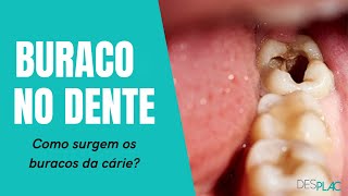 BURACOS NOS DENTES  COMO SURGEM [upl. by Gabrielson]