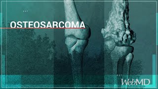 Basics Osteosarcoma  WebMD [upl. by Elizabet]