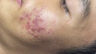 ACNE TREATMENT VU QUYNH MI Acne On Teens Cheek 2024 [upl. by Adlog]