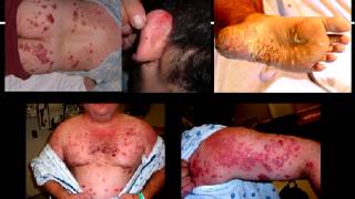 Stelara Side Effects  Stelara causes drug induced psoriasis  Biologic problems [upl. by Ankeny241]