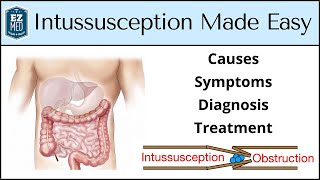 Intussusception Causes Symptoms Diagnosis Treatment Nursing USMLE [upl. by Eveineg]