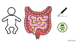 Necrotizing Enterocolitis [upl. by De]