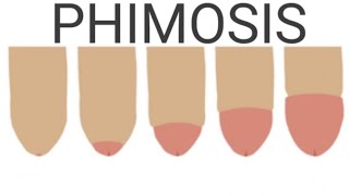 Phimosis  IntroductionTypesCausesRisk factorsSings amp SymptomsDiagnostic Test and Management [upl. by Adigirb]