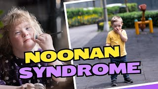 What is Noonan Syndrome  Symptoms Treatment Causes Prognosis [upl. by Vallonia]