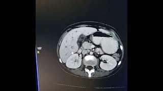 Liver abscess  Periportal haloPeriportal collar sign [upl. by Eugirne366]