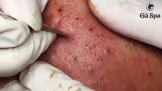 Blackheads 7750 [upl. by Luci]