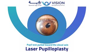 Laser pupilloplasty for updrawn pupil HM to 636 immediately postop [upl. by Beauvais212]