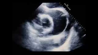 Transthoracic Echocardiogram Showing Pericardial Tamponade [upl. by Aiyot]