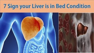 7 Sign your Liver is in Bed Condition  Warning Signs That Something Is Wrong With Your Liver [upl. by Joash597]