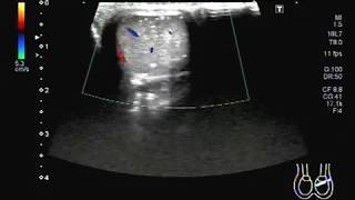 Ultrasound Video showing Testicular microlithiasis A rare case [upl. by Naesar]