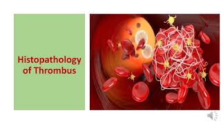 THROMBOSIS TYPES  HISTOPATHOLOGY CONSEQUENCES DIAGNOSIS AND PREVENTION [upl. by Gnilrets]