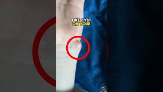 Remove This Dangerous Cyst At Home😨 shorts [upl. by Nytsirc]