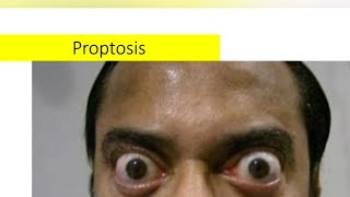 Proptosis  etiology type and work up protocol [upl. by Richelle]