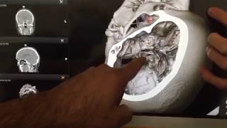 MCA Series clip1 of 5  Brain aneurysm surgery  Interactive neuronav 3D CTA [upl. by Ramyaj795]