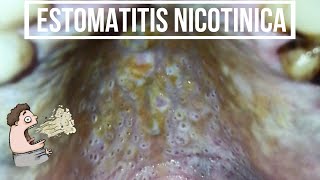 ESTOMATITIS NICOTÍNICA  Paladar del fumador Hiperqueratosis DE LA MUCOSA DEL PALADAR Odontología [upl. by Huesman844]