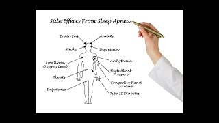 Sleep Apneas Side Effects [upl. by Akira]