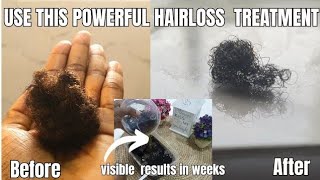 Dont Rinse OutOnly 3 ingredients to stop hair loss in weeks ALOPECIA AREATA TREATMENT [upl. by Anikram]