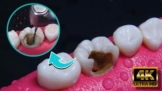 INCREIBLE reconstrucción de diente dañado por caries Endodoncia en 4K [upl. by Burr]