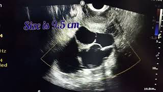 How to diagnose a complex adnexal mass by Simple IOTA RULESvivekanandahospitalofficial [upl. by Osugi411]