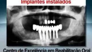 Implantes dentários com carga imediata [upl. by Lardner]