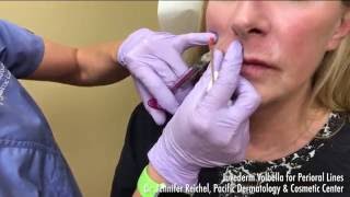 Juvederm Volbella Demo for Perioral Lines around the lips  2068595777 [upl. by Rammus]